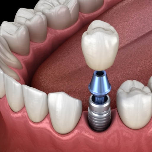 Animated smile during single dental implant placement