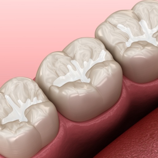Animated smile with tooth colored fillings