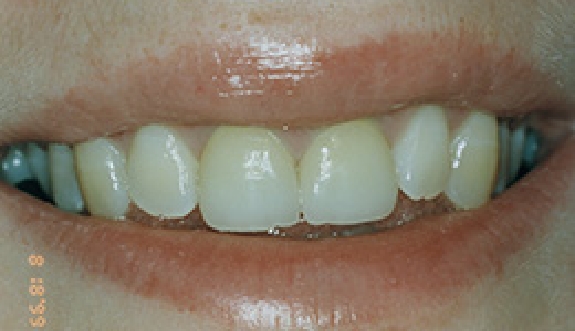 Smile with repaired front teeth