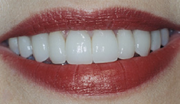 Bright smile after cosmetic dentistry