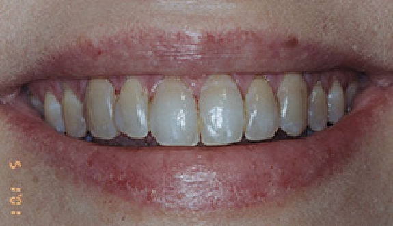 Discolored smile before cosmetic dentsitry