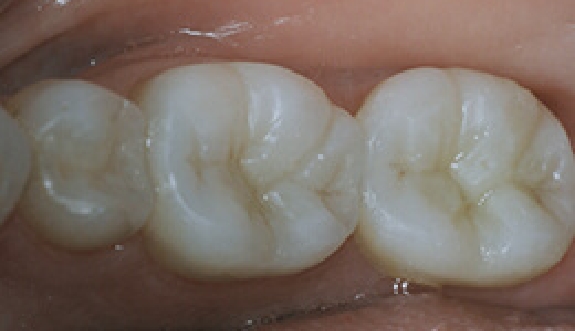 Smile with new tooth colored dental restorations