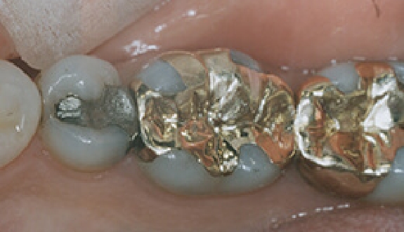 Smile with several large metal fillings