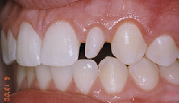 Smile with damaged top side tooth