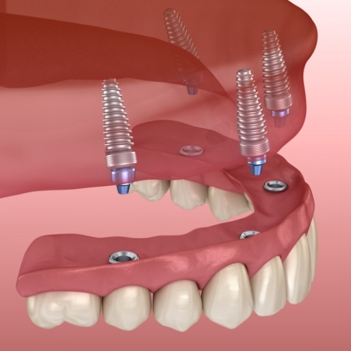 Animated smile during all on four dental implant placement
