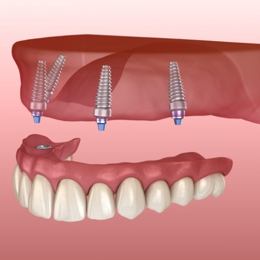 Animated smile showing all on four dental implant process