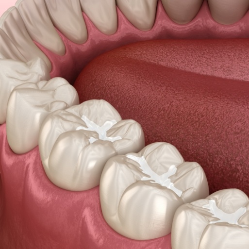 Animated smile with dental sealants