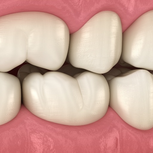 Animated smile repaired with tooth colored fillings