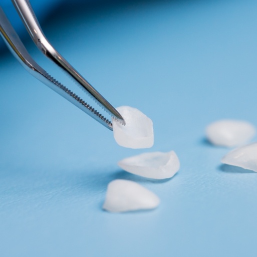 Porcelain veneers prior to placement