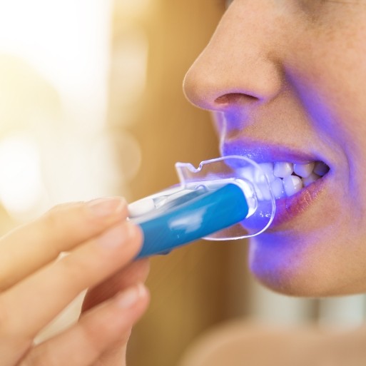 Dental patient using at home teeth whitening kit