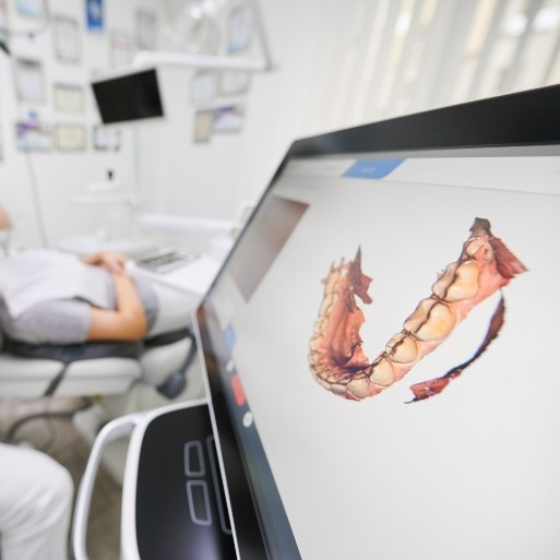 Digital impressions of smile before gum recontouring