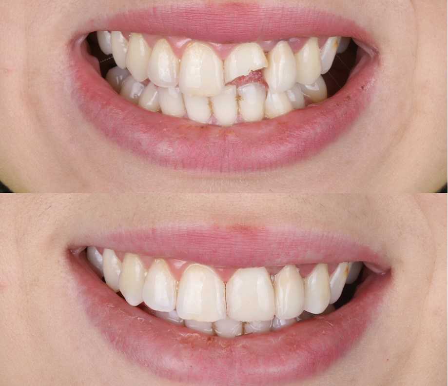 Cosmetic dental bonding can repair chipped teeth