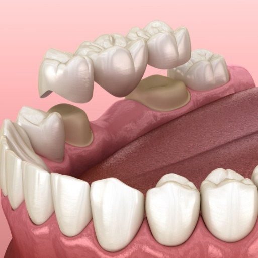 Animated smile during dental bridge placement