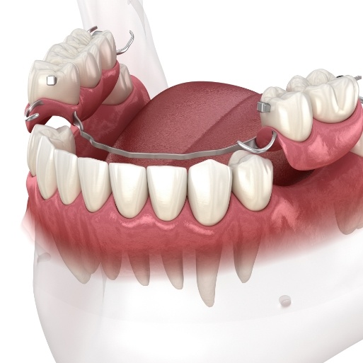 Animated smile during partial denture placement
