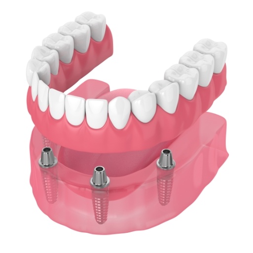 Animated smile during full denture placement