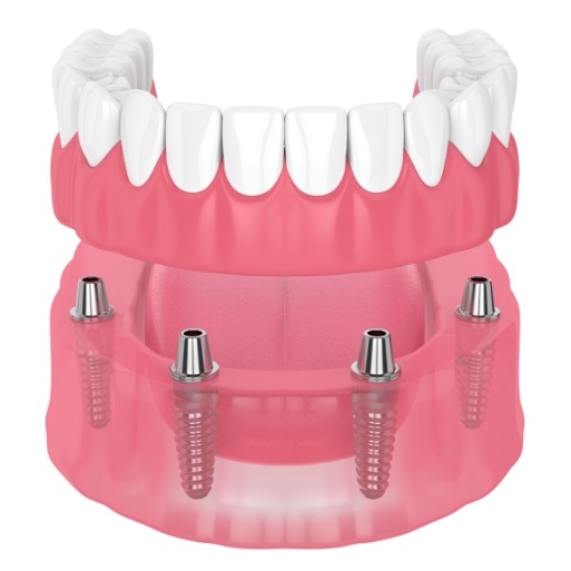 Animated smile during dental implant supported denture placement