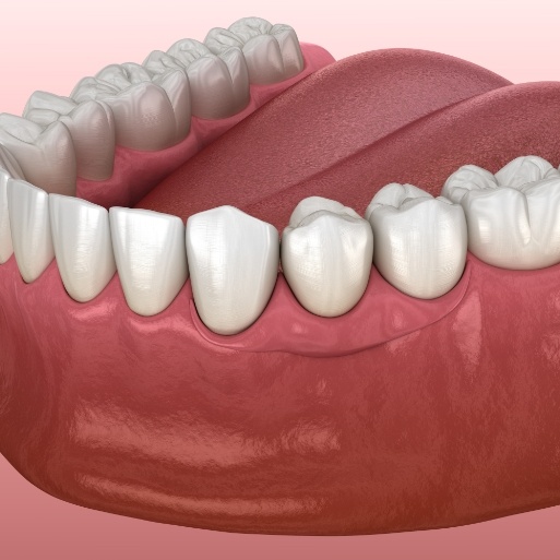 Animated smile with denture in place