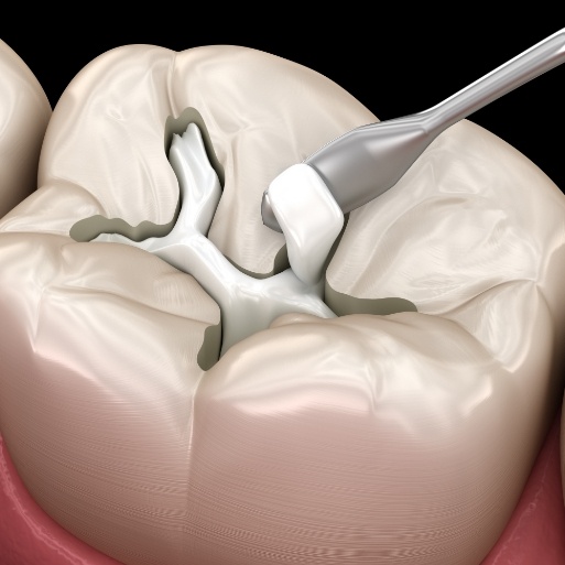 Animated smile during tooth colored filling process