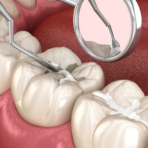 Animated tooth receiving tooth colored filling