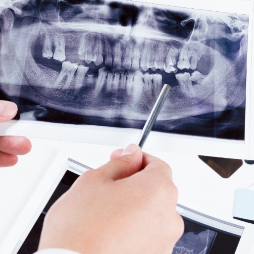 X-ray of smile with several missing teeth before dental implants