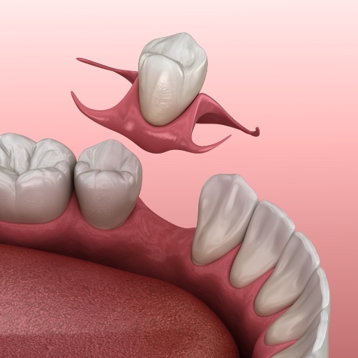 Animated smile during dental bridge placement