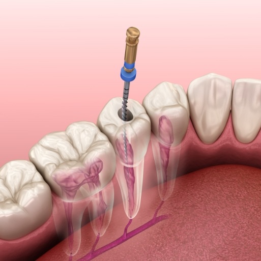 Animated smile during root canal therapy