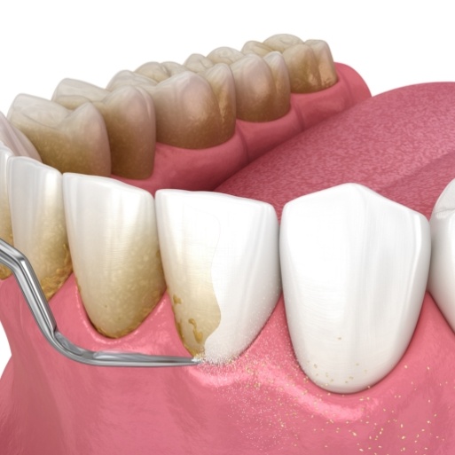 Animated smile during scaling and root planing treatment