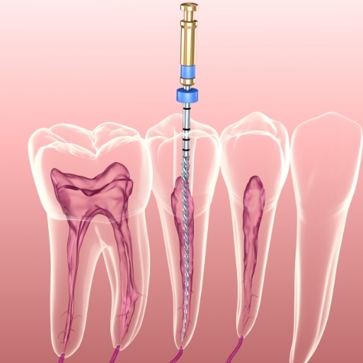 3 D rendering of root canal therapy process