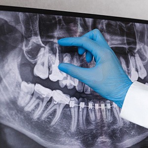 Dentist reviewing patient’s X-ray