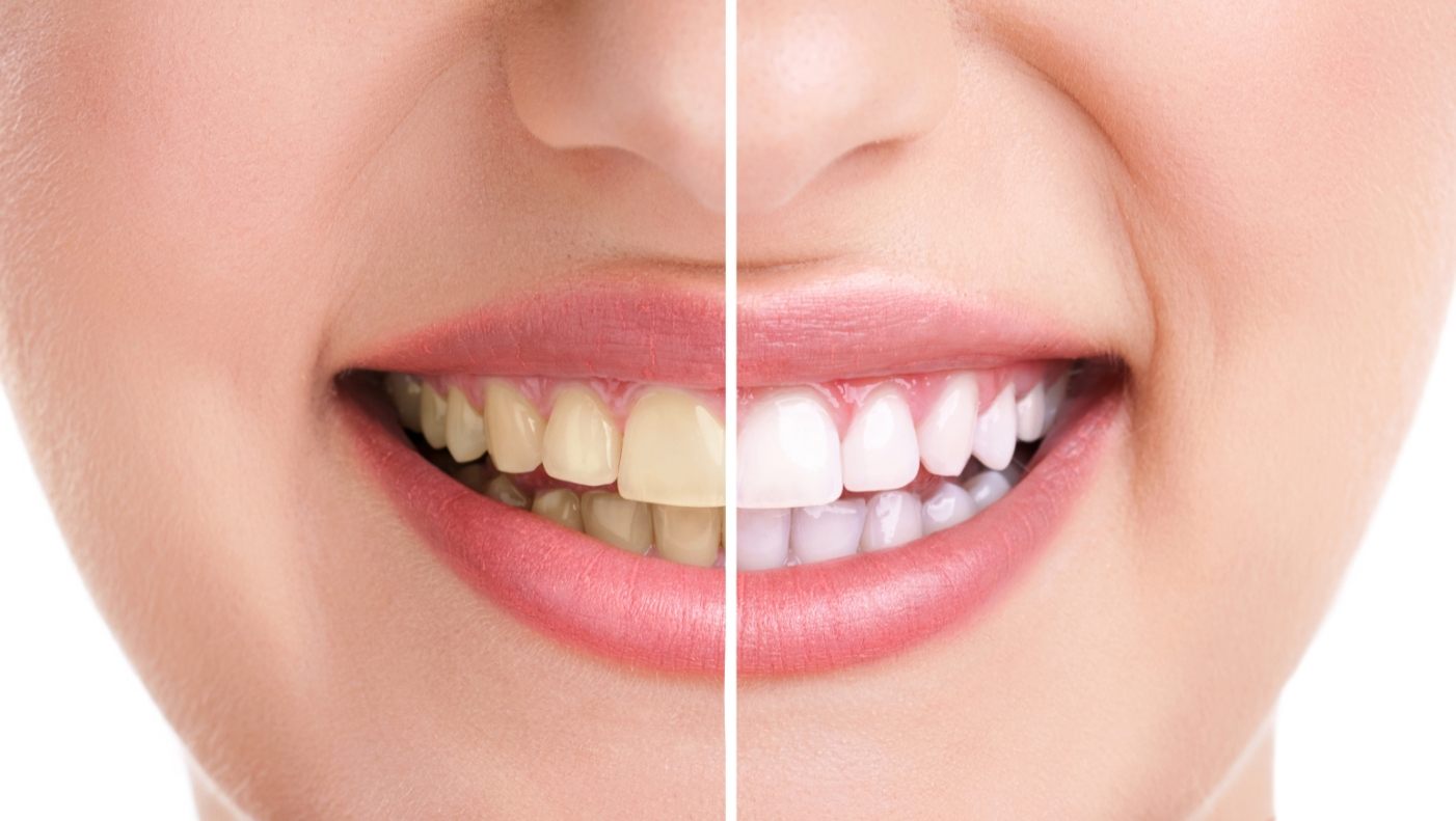 Woman's smile before and after teeth whitening