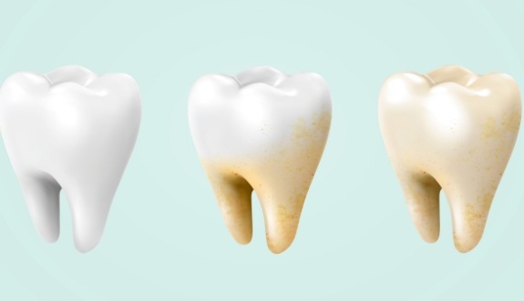 Teeth before and after teeth whitening