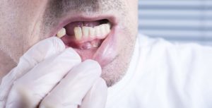 damaging a permanent tooth in State College