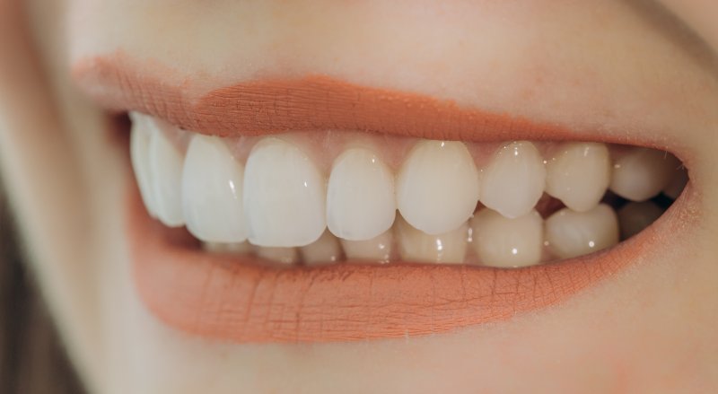 Woman with dental veneers