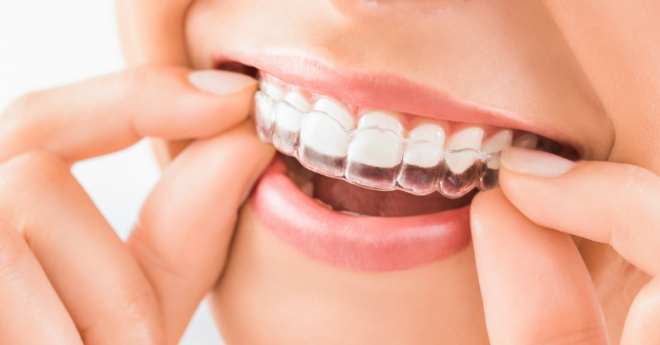 Woman with Invisalign clear aligner